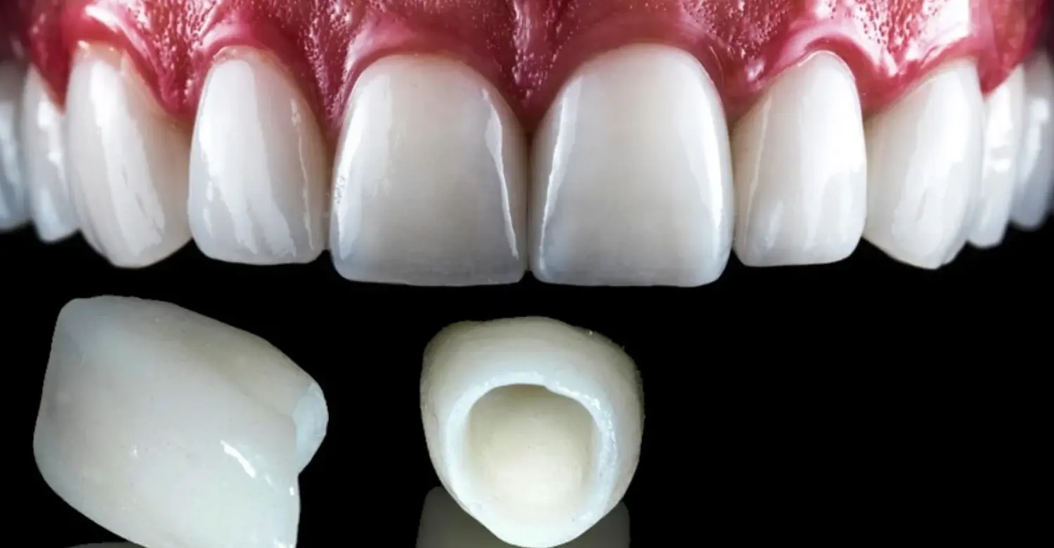 E.max vs Zirconia Crowns Differences 2